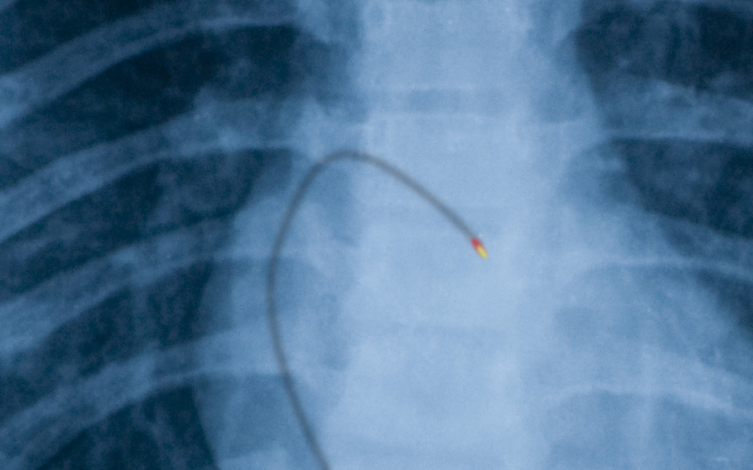 Robotic Catheterization For Cardiac Arrhythmias