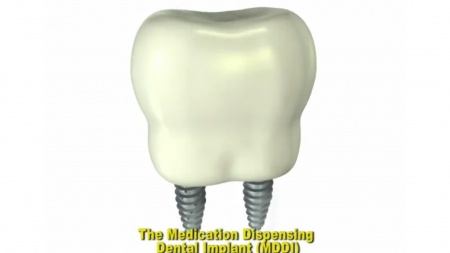 Medication Dispensing Dental Implant Overview
